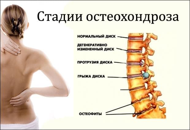 Остеохондроз: симптомы и эффективное лечение